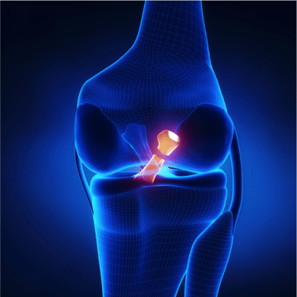 ACL Physiotherapy Penrith