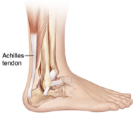 tendinopathy