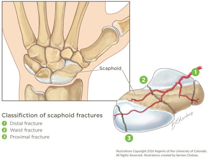 scaphoid fracture physiotherapy wrist pain